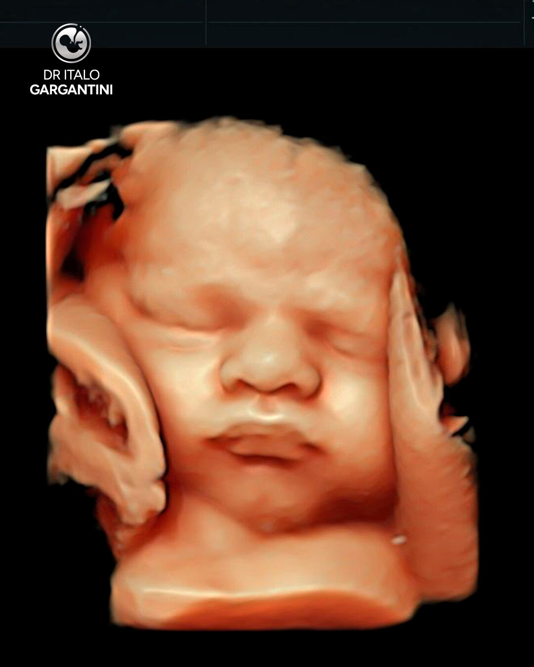 Dr. Italo Gargantini: peça 3 do marketing para Medicina Fetal